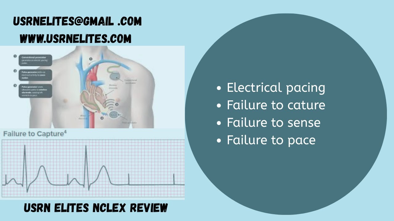 Electrical Pacing Explained