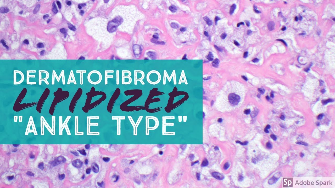 Dermatofibroma, Lipidized (