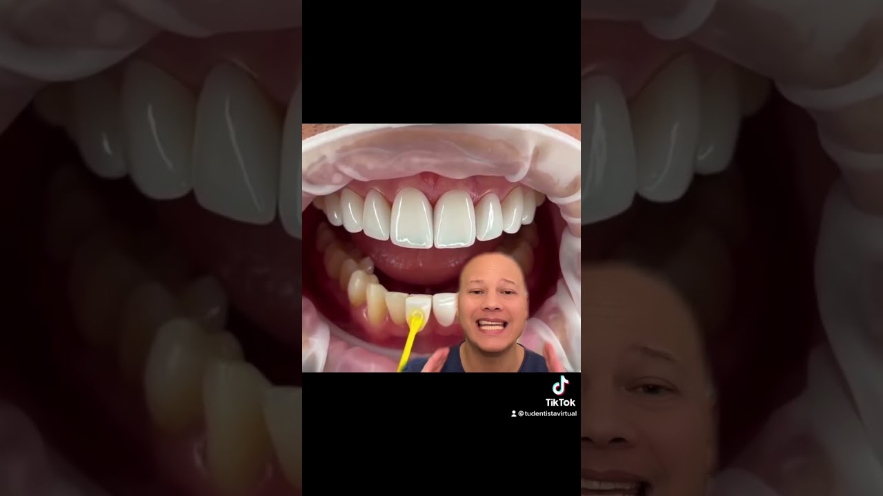 Carillas dentales de cer&aacute;mica, debes saberlo&hellip;