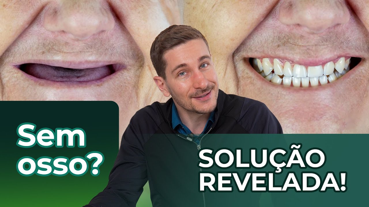 SEM OSSO para implantes? O SEGREDO do procedimento que funciona!