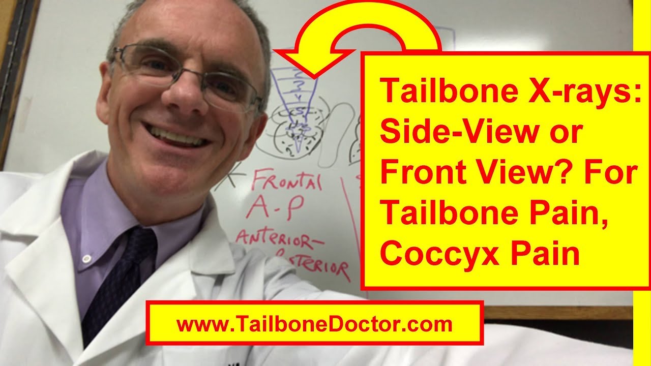 Coccyx X-rays: Side-view vs Front-view, for Tailbone Pain, Coccyx Pain