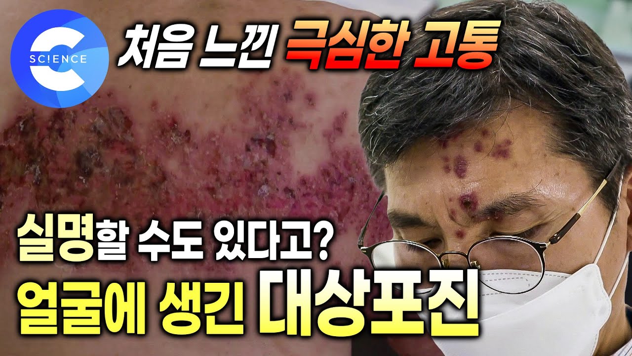 치료시기 놓치면 실명? 눈에 생긴 통증의 왕 '대상포진' | 면역력이 떨어지기를 기다리는 수두 바이러스 | 신경을 타고 나타나는 대상포진 | 명의