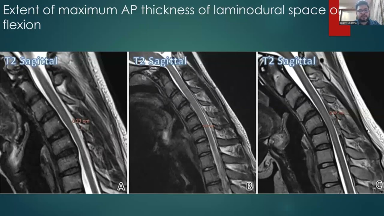 Ojasvi Sharma | Cervical Spine MRI findings in Hirayama Disease