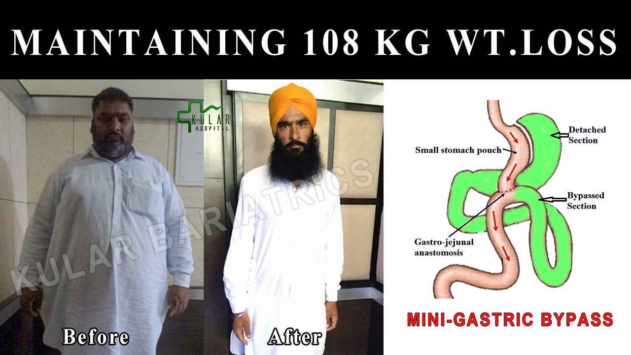 After 8 years of MGB (Mini-Gastric Bypass)/Weight loss surgery...