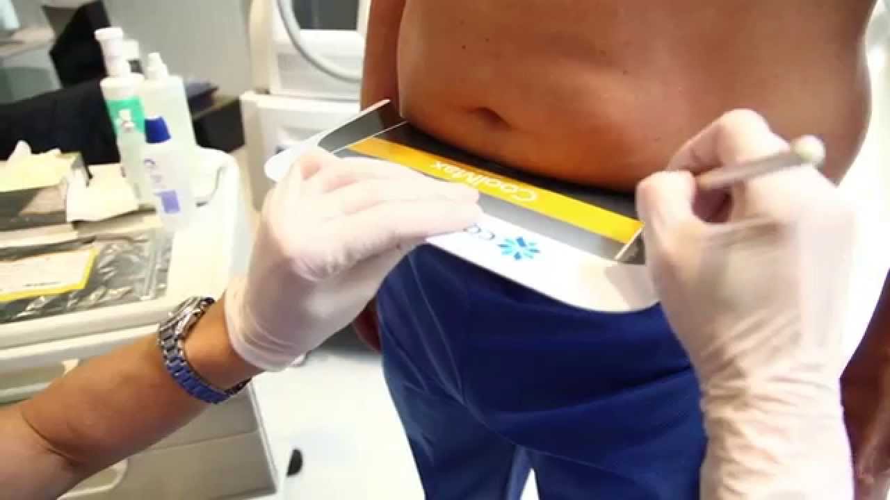 Le déroulement d'une séance de CoolSculpting Zeltiq