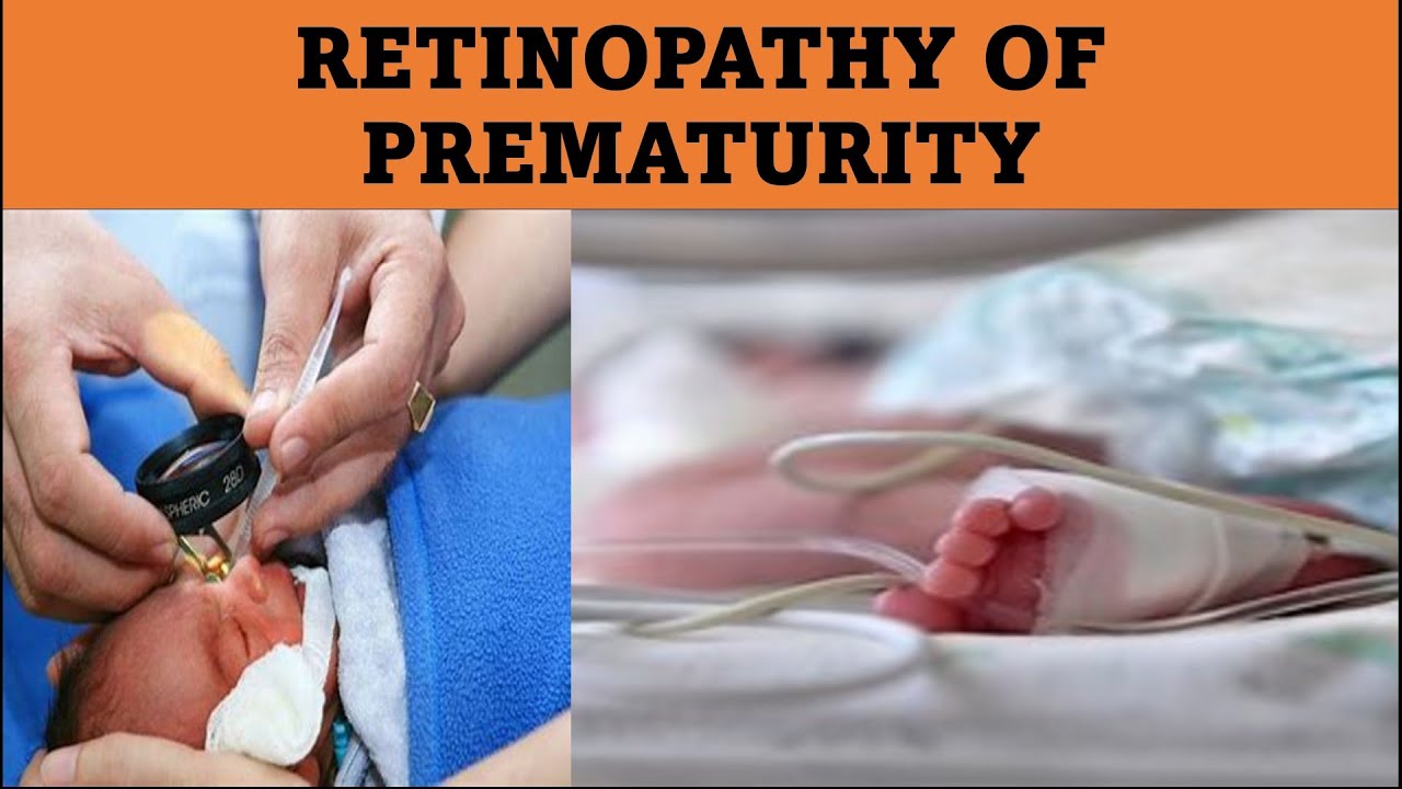 What Causes ROP | Retinopathy of prematurity