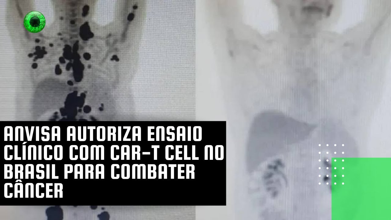 Anvisa autoriza ensaio clínico com CAR-T Cell no Brasil para combater câncer