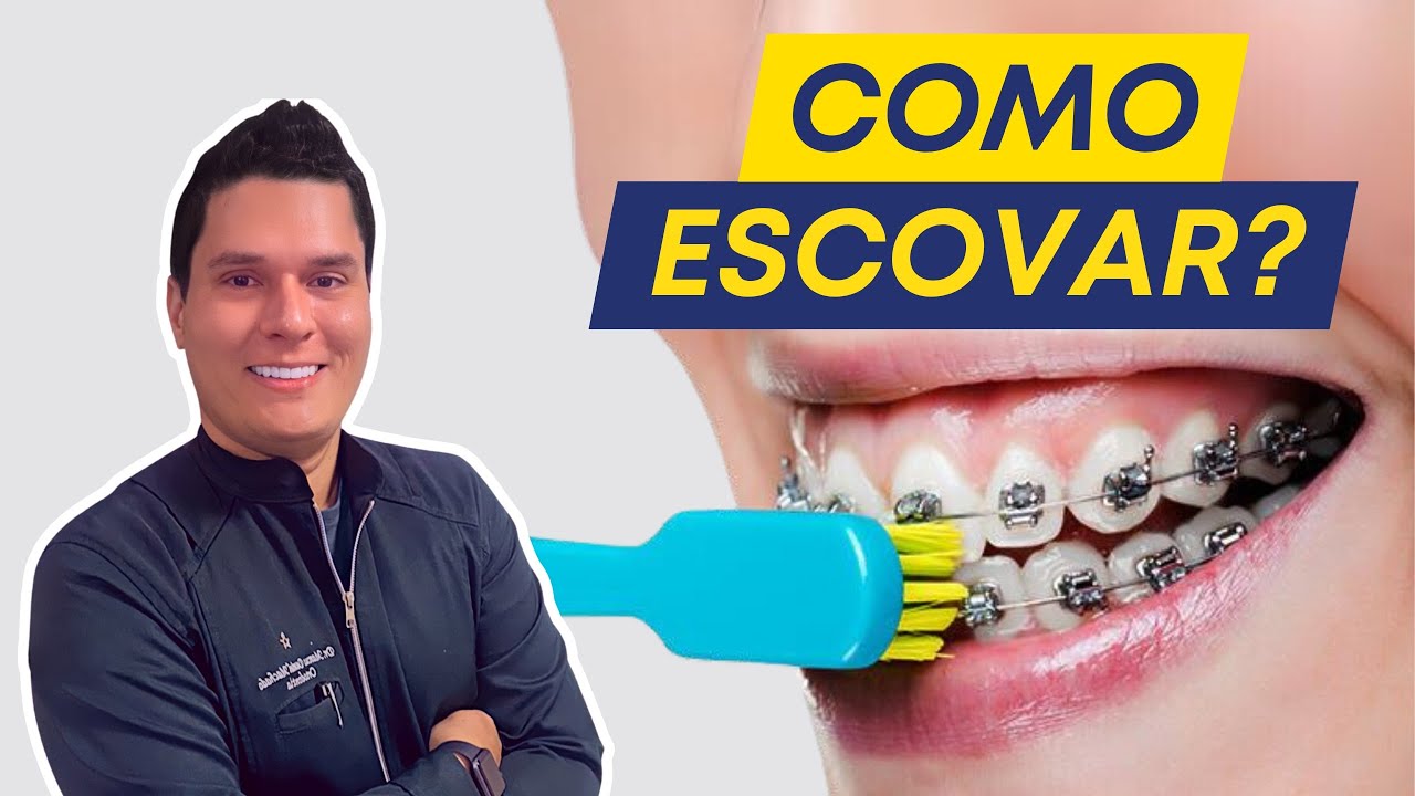 Como ESCOVAR OS DENTES com APARELHO ORTODÔNTICO Corretamente? (Guia Passo a Passo).