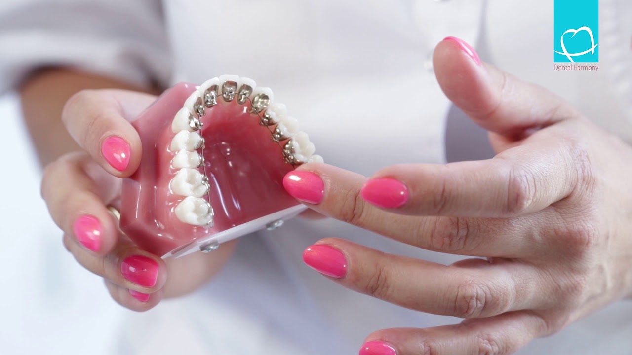 Kokios yra dantų tiesinimo aparatų (breketų) rūšys?