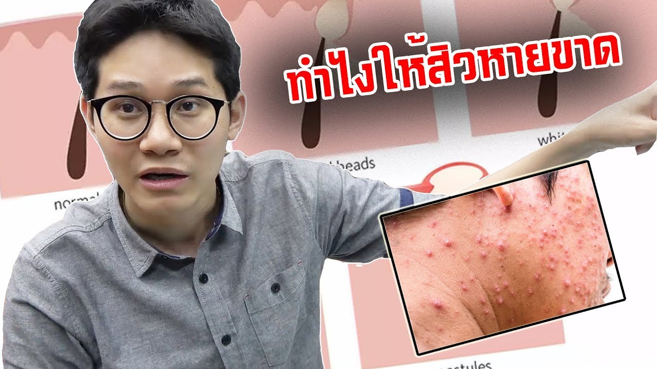 ถ้าไม่อยากให้มีสิวขึ้นต้องทำอย่างไร?