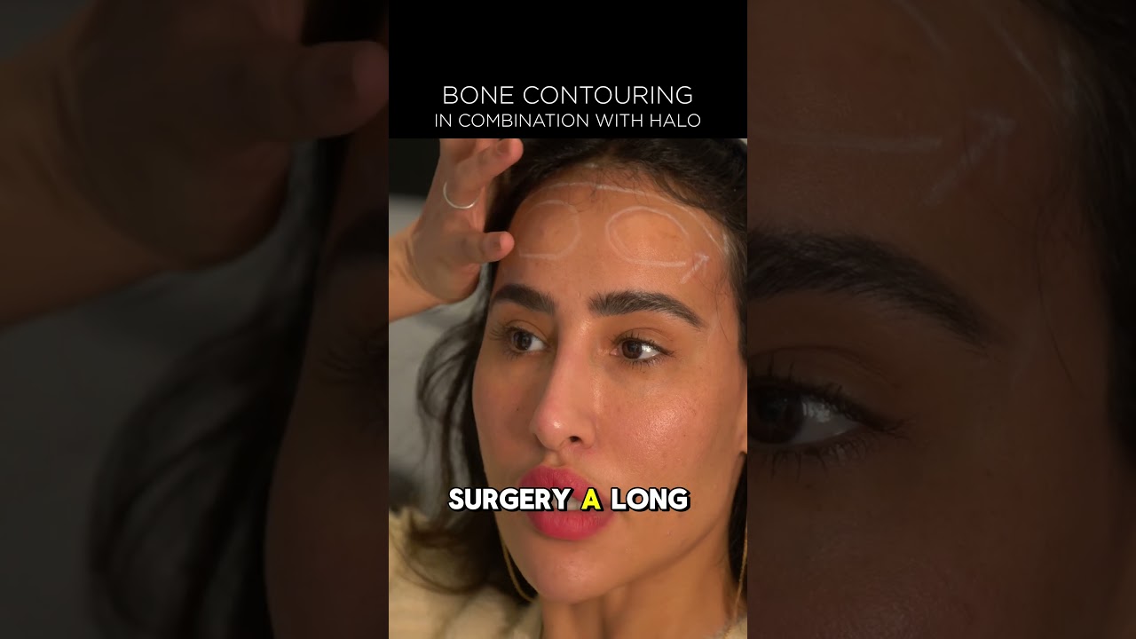 Can You Combine HALO Surgery with Forehead Bone Contouring?