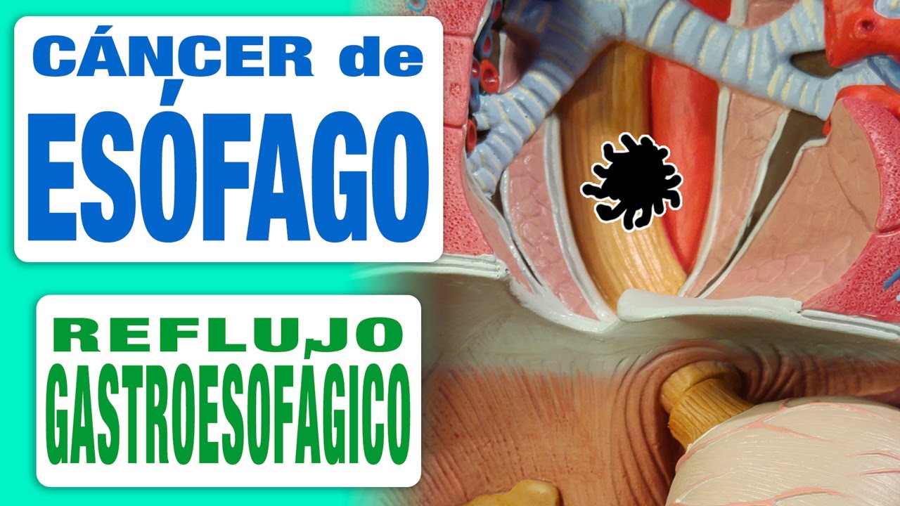 C&aacute;ncer de Es&oacute;fago y Reflujo Gastroesof&aacute;gico