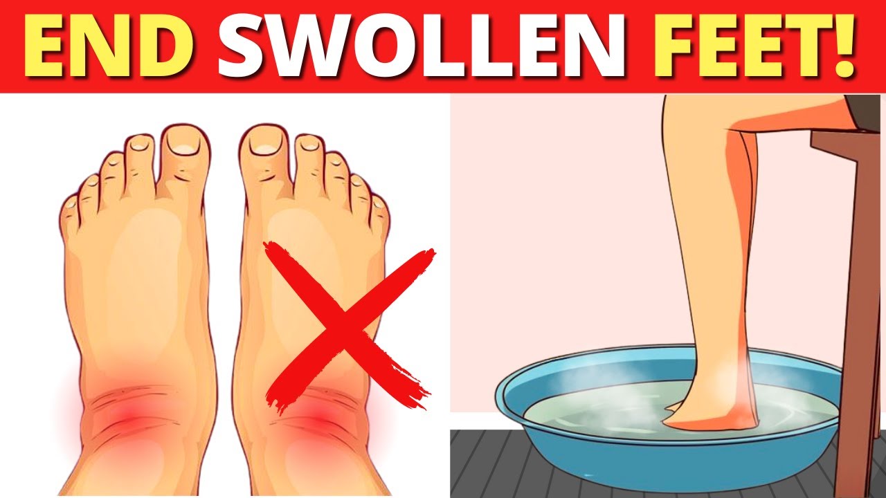 12 Easy Home Remedies to Eliminate Swollen Feet Now!