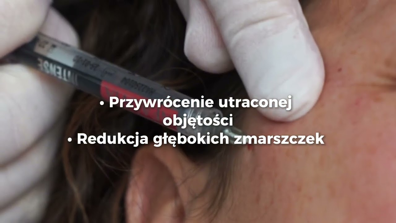 Zabiegi z użyciem Organicznego Kwasu Hialuronowego w Klinice Miracki &hearts;️