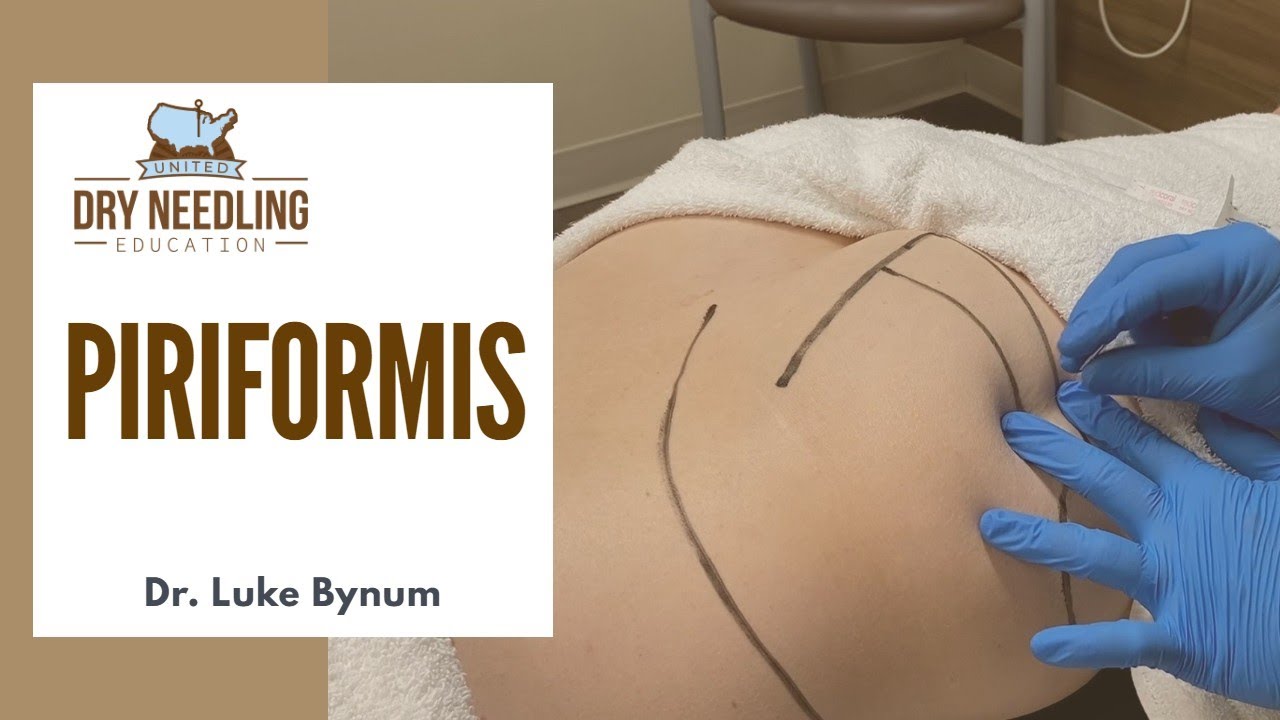 Dry Needling Piriformis