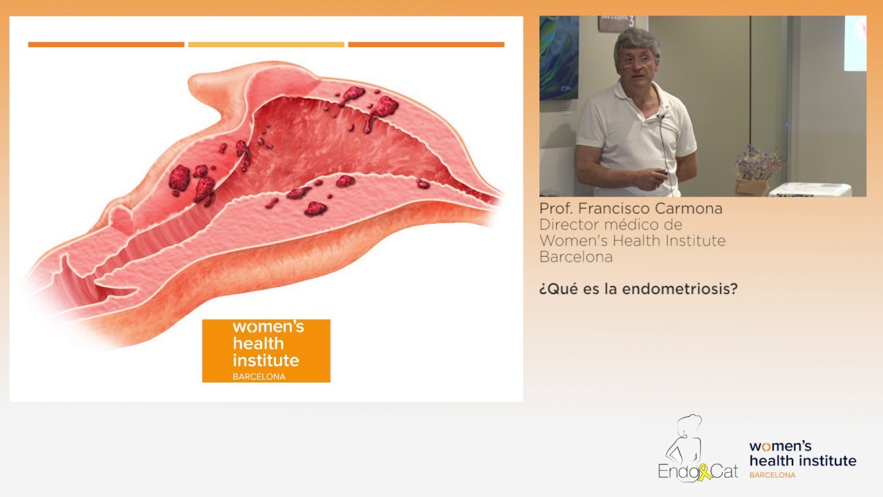 Dr. Francisco Carmona ¿Qué es la Endometriosis?