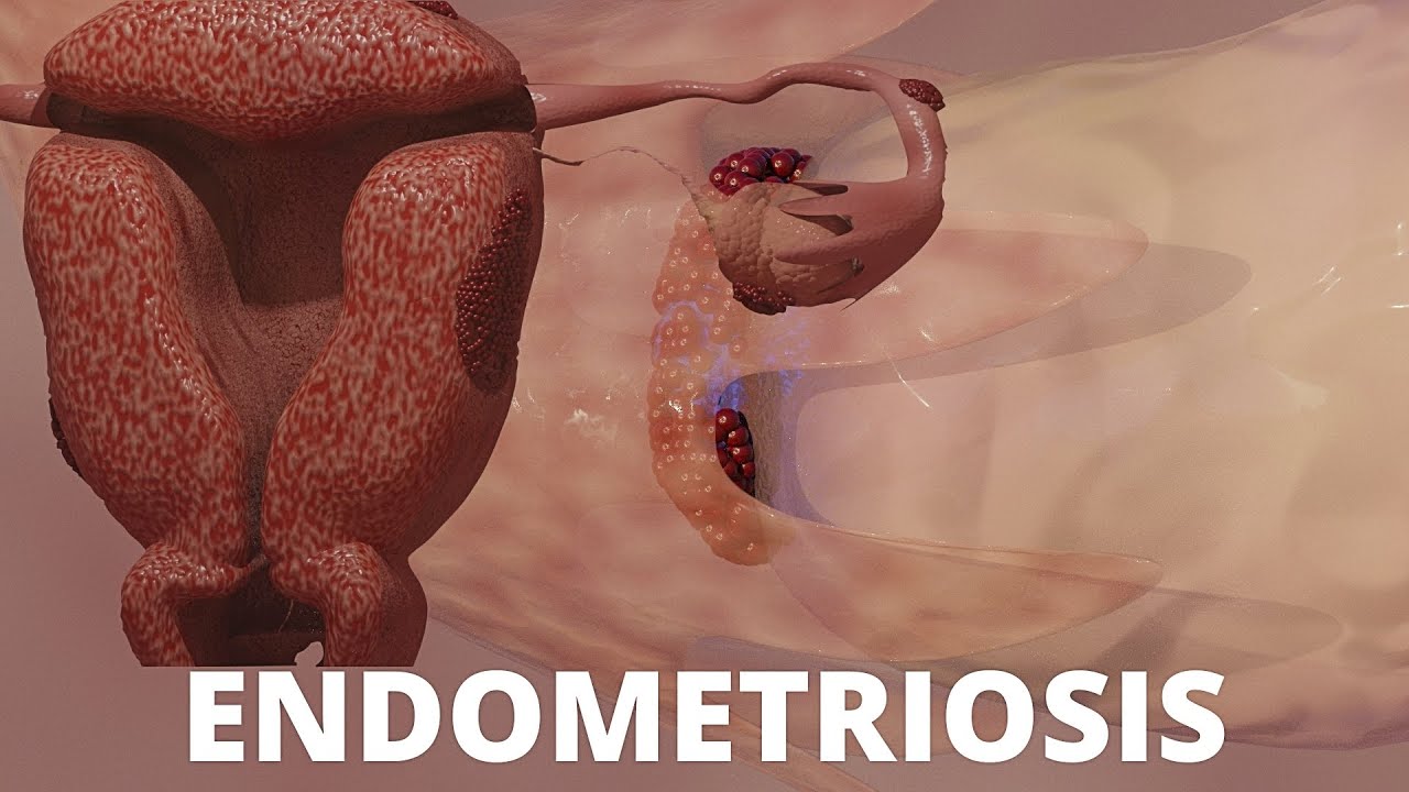 #Endometriosis #Infertility #periodpain Animation on Endometriosis. Why it causes pain & infertility