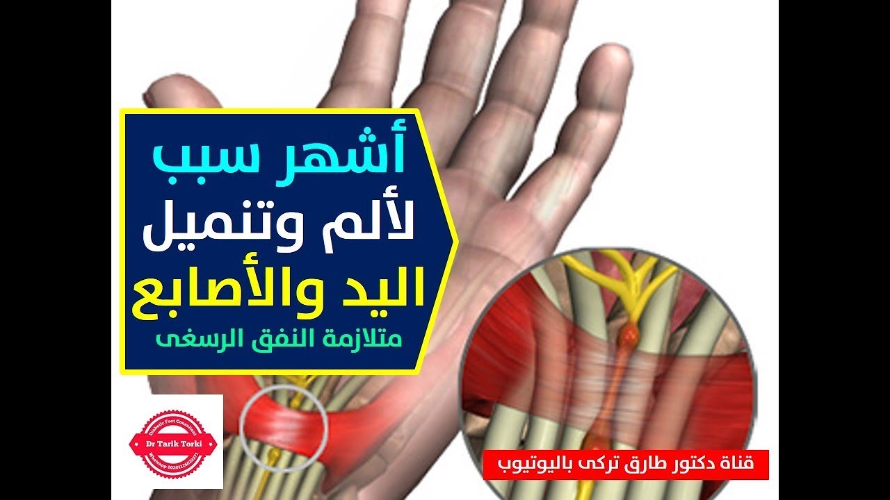 اشهر سبب لالم وتنميل اليد والاصابع | متلازمة النفق الرسغى | ايدك بتوجعك وتنمل .. شاهد هذا الفيديو