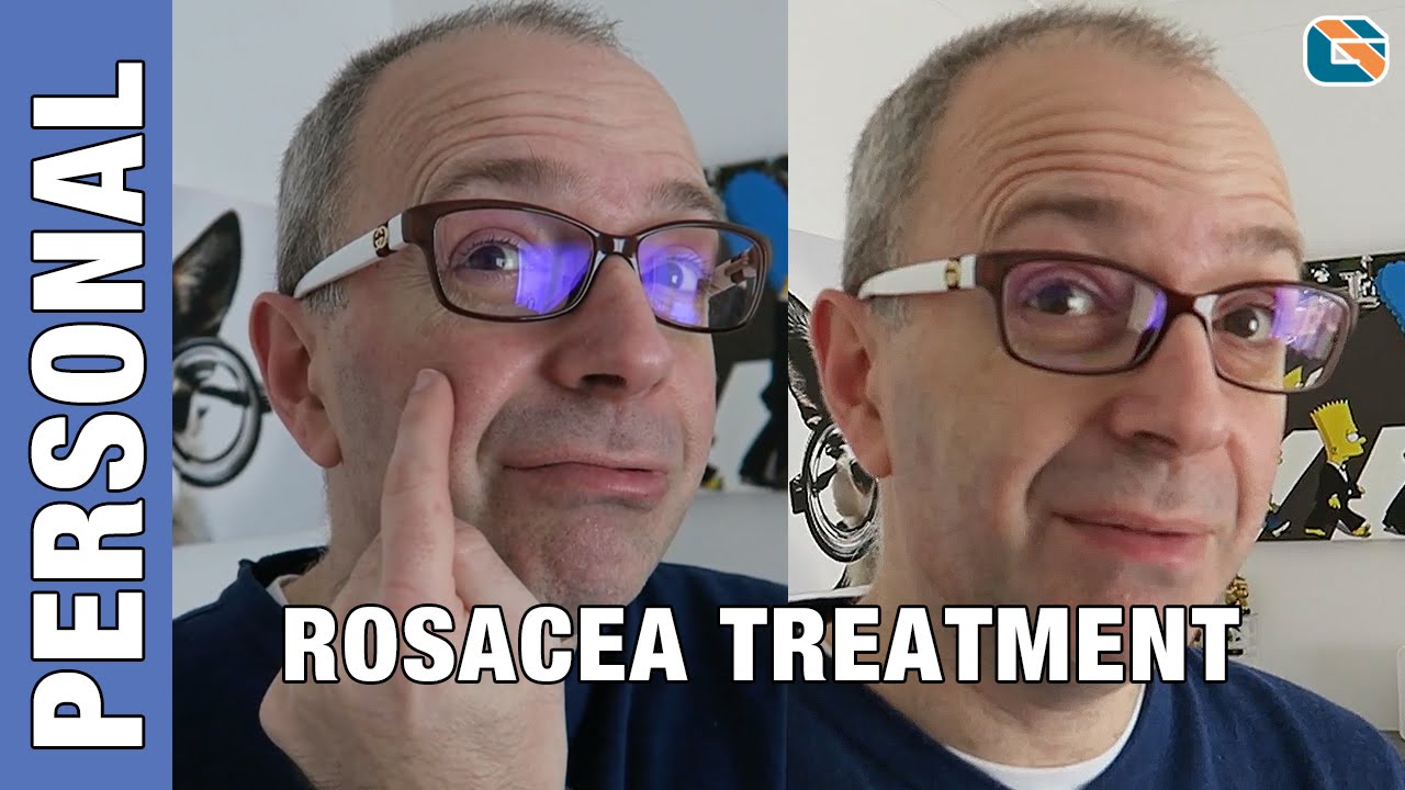 Rosacea Mirvaso Gel Cream Treatment Test - Geek Vlog 376 #Rosacea