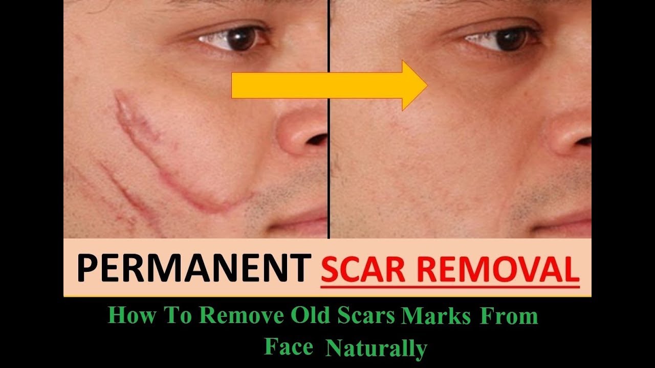 how to remove old scars marks