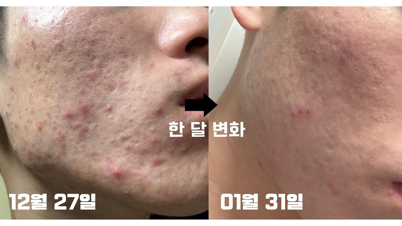 피부과 X, 집에서 한 달만에 피부 좋아진 “저수열자” 기법