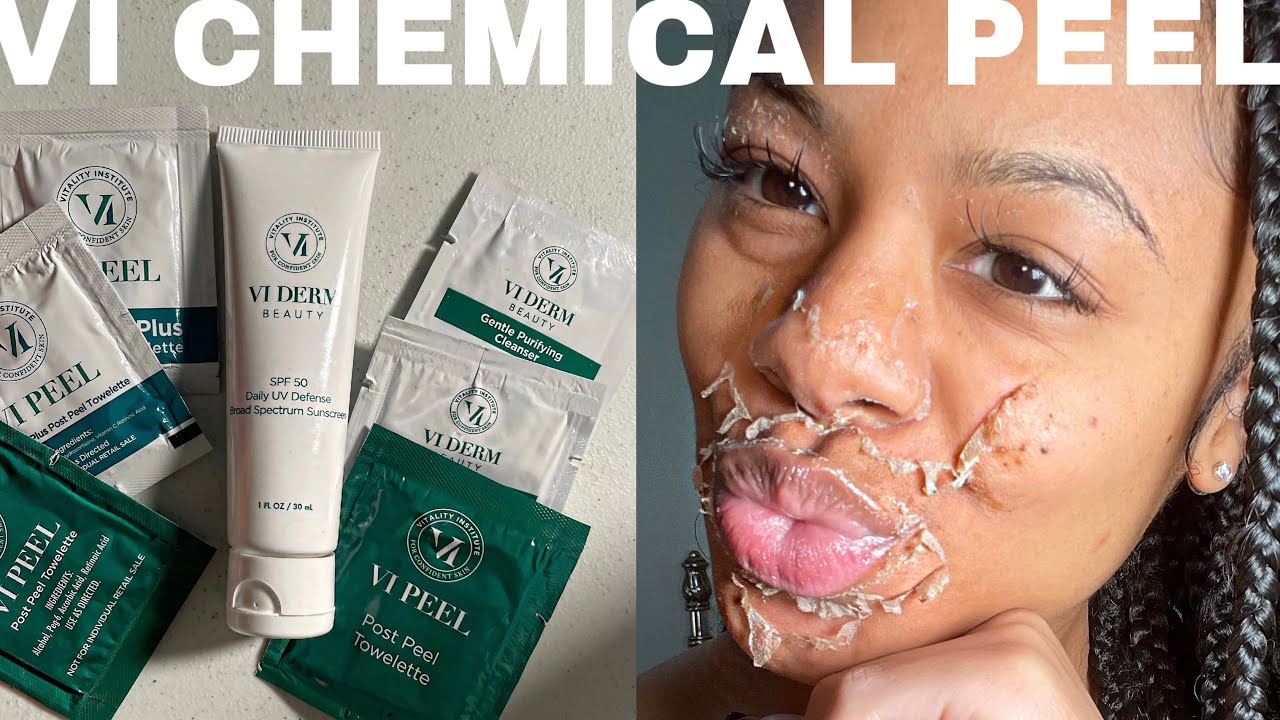 VI Precision Plus Chemical Peel FULL Process | Addressing Perioral Hyperpigmentation Around Mouth