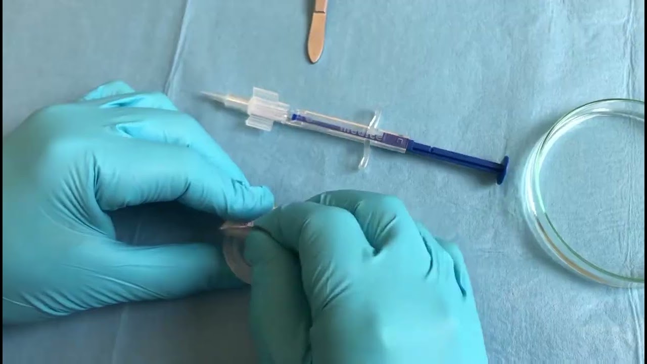 Loading of the Accuject BL Injector with the Acunex lens