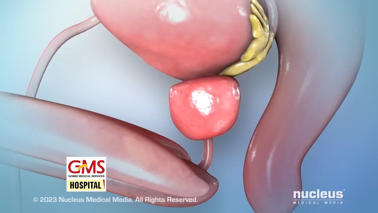 Difference between prostate enlargement and prostate cancer #Carebeyond24/7