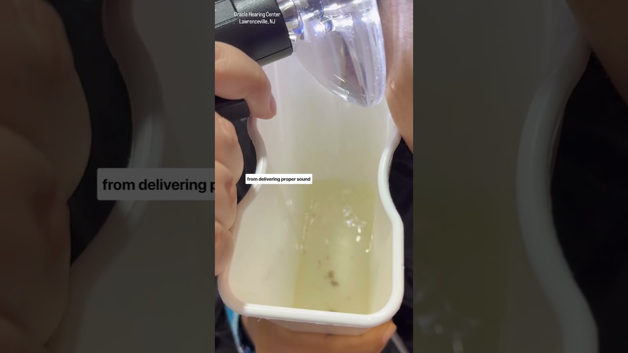 Earwax removal: M&eacute;xico Humanitarian Edition