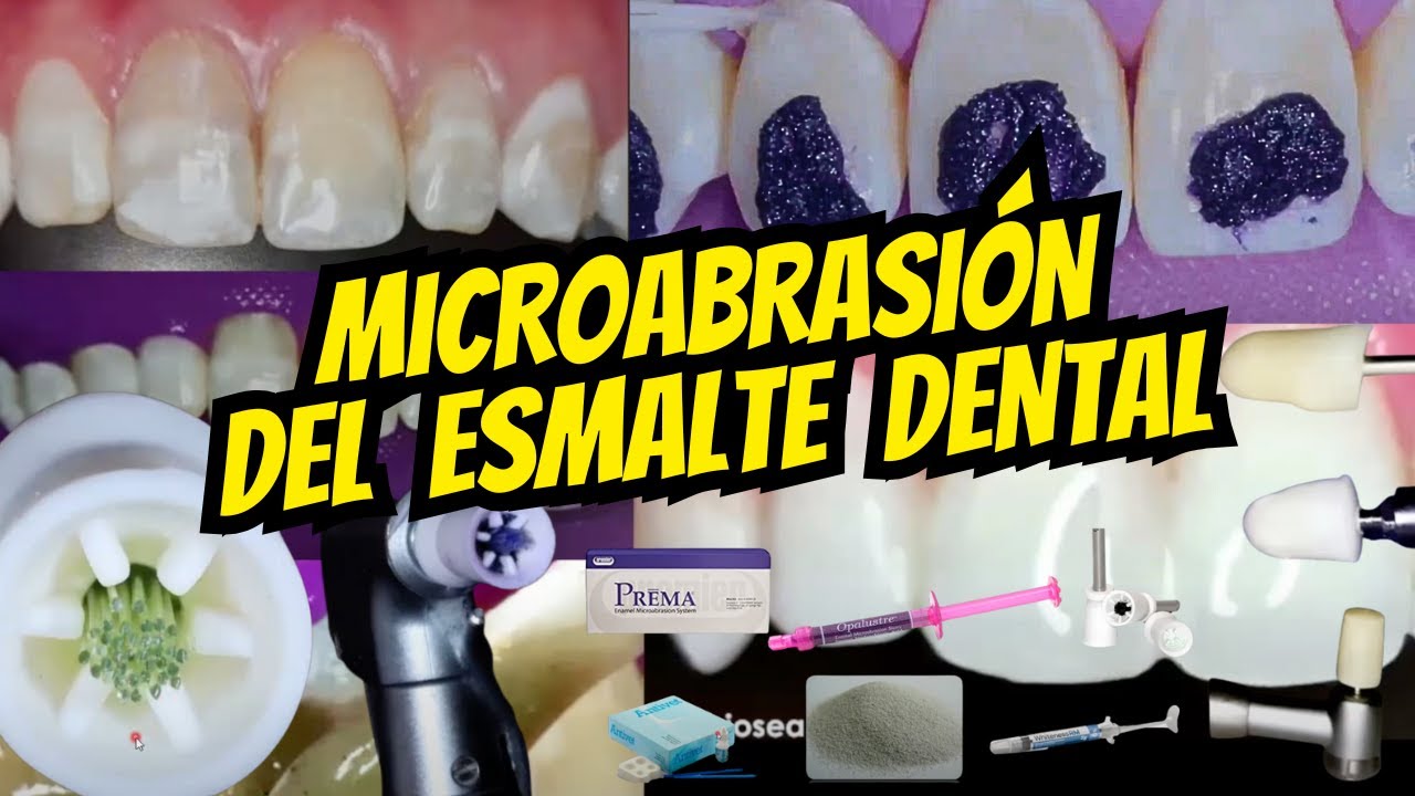 Microabrasión del Esmalte Dental