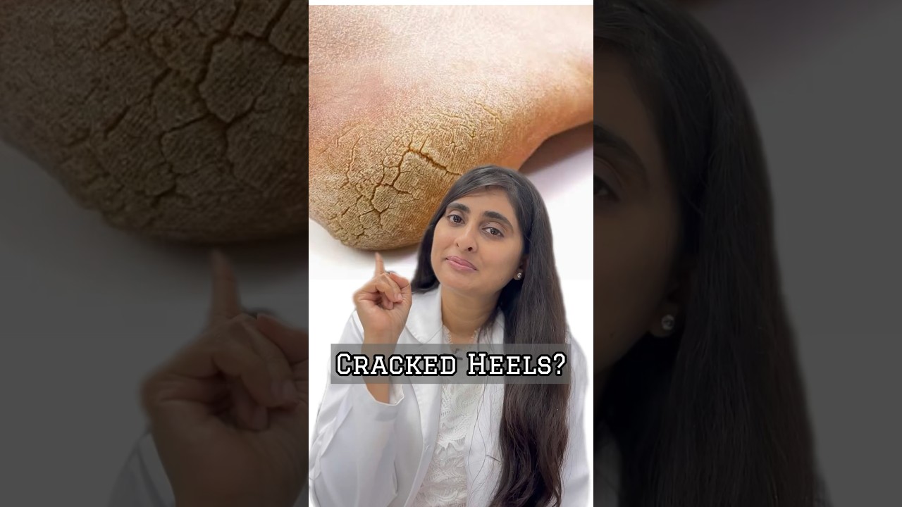 How to treat cracked heels | Cracked heels treatment | Foot cream for cracked heels