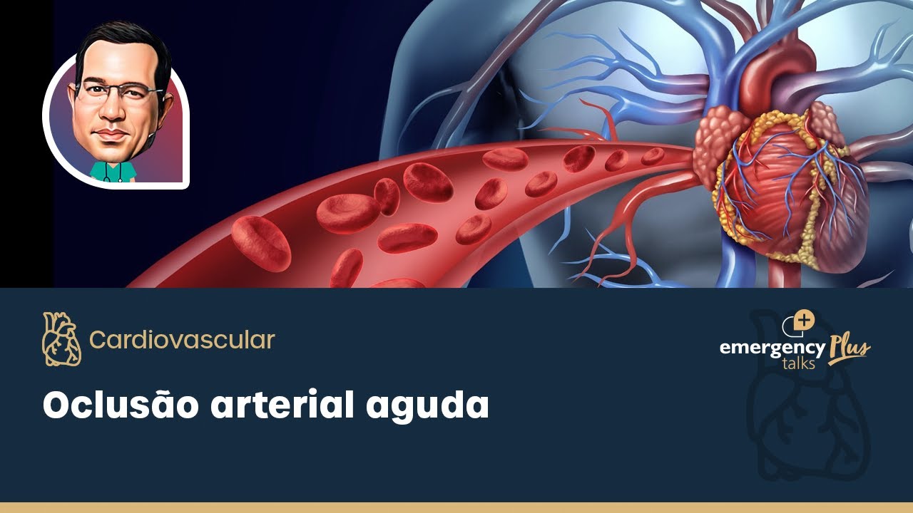 Oclus&atilde;o arterial aguda