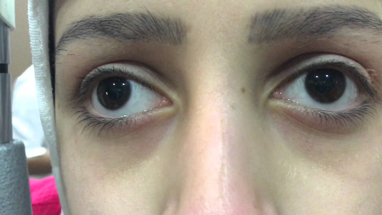 See saw Nystagmus