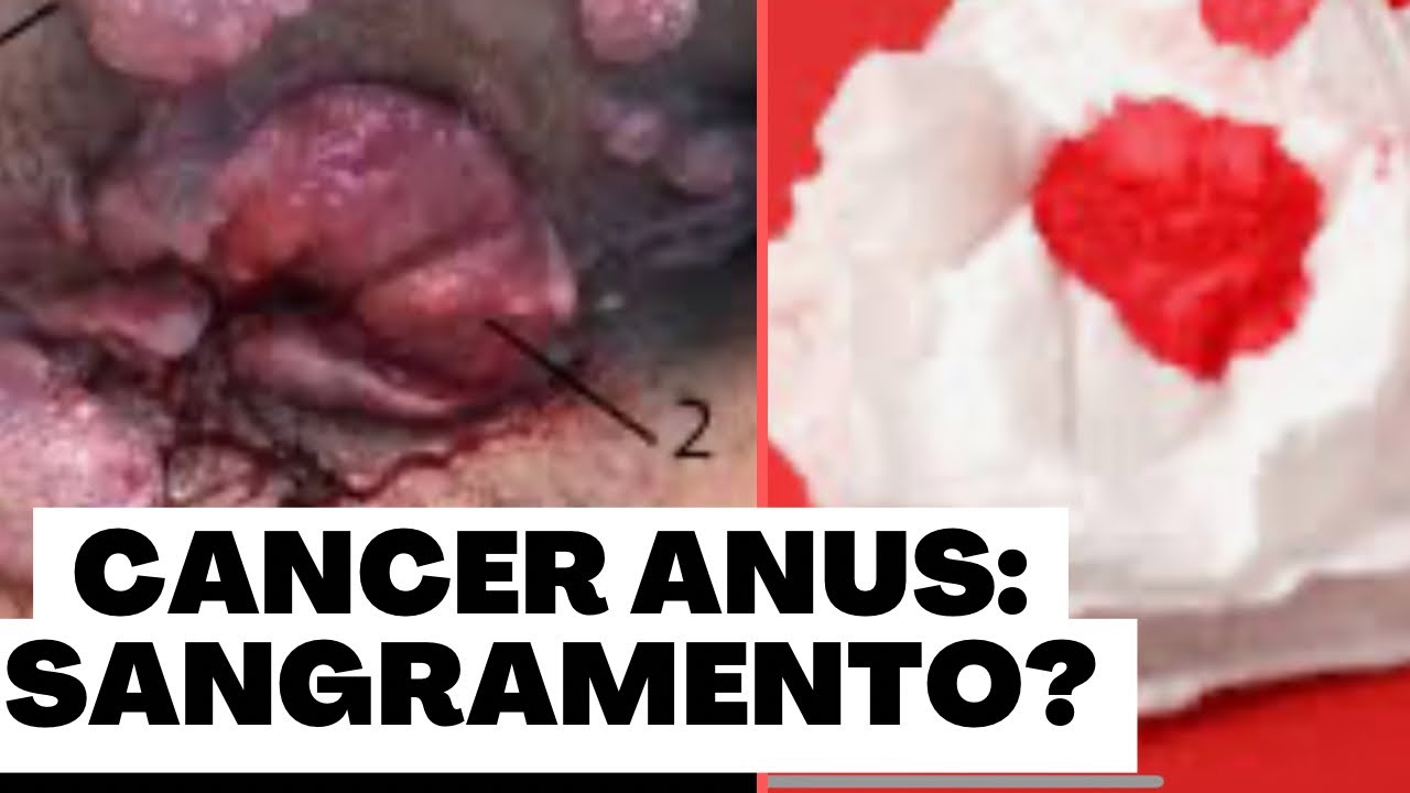Câncer anus:Saibam c/ é o  sangramento desse tumor no grupo de  risco explica Dr Paulo Branco: