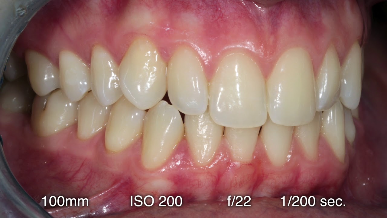 Digital Dental Photography (4 of 9) Fotografia Intraorale inquadrature e devices parte 1