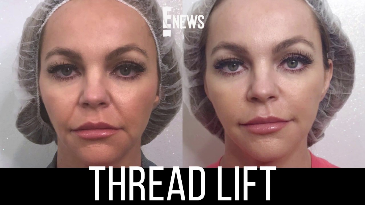 Before and After Sugar Thread Lift - Nurse Jamie on E News!