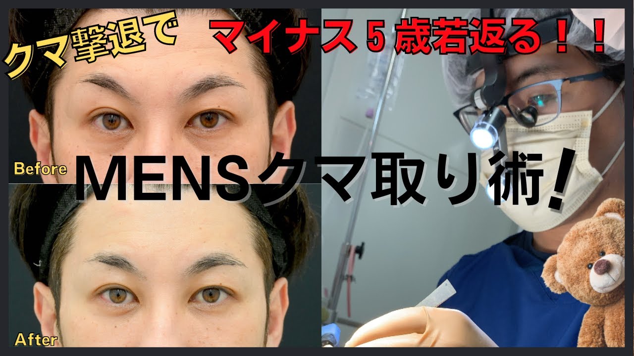 【山本院長が解説！】男性のクマ取り術！目の下のクマを取ってマイナス５歳目元へ！