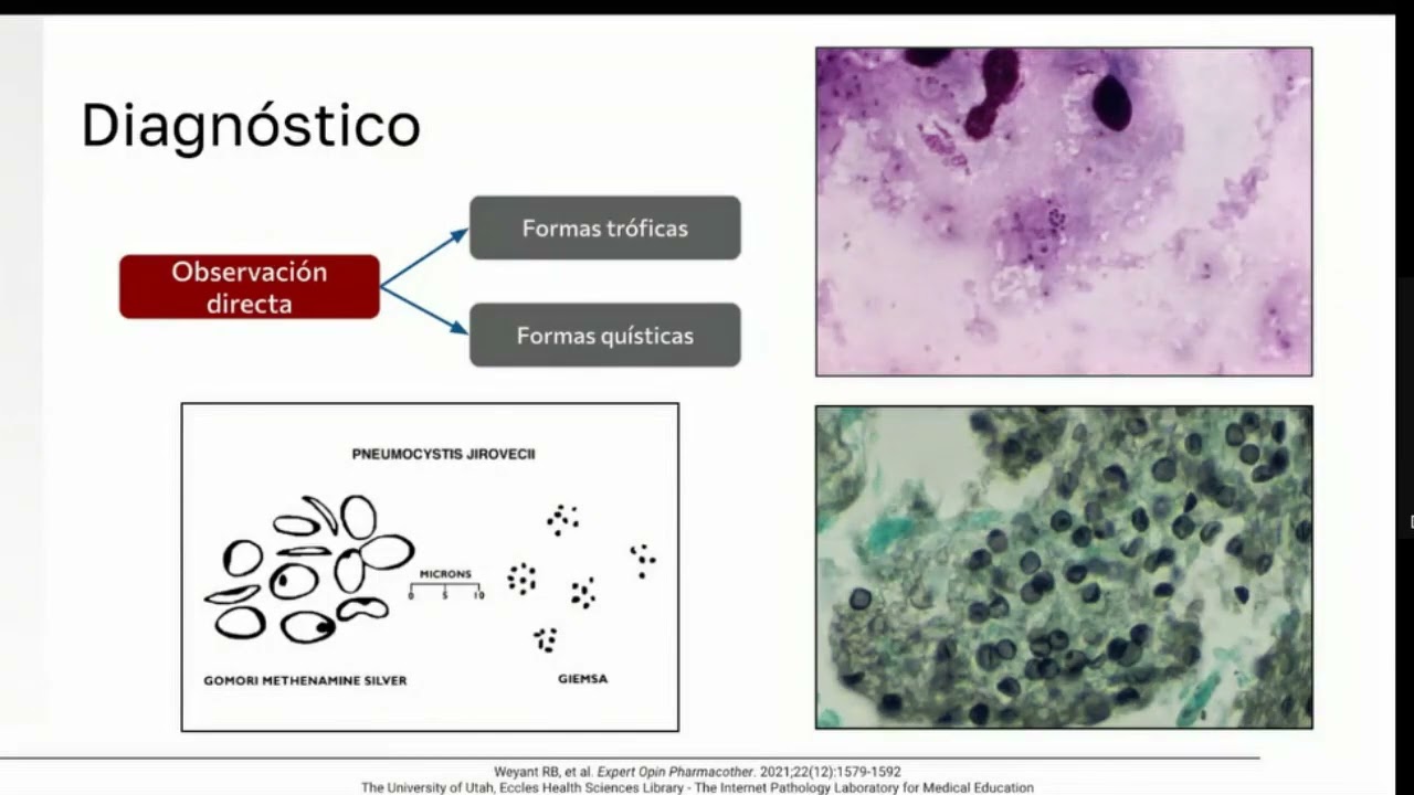 Infección pulmonar y extrapulmonar por Pneumocystis jirovecii -posgrado Infectología