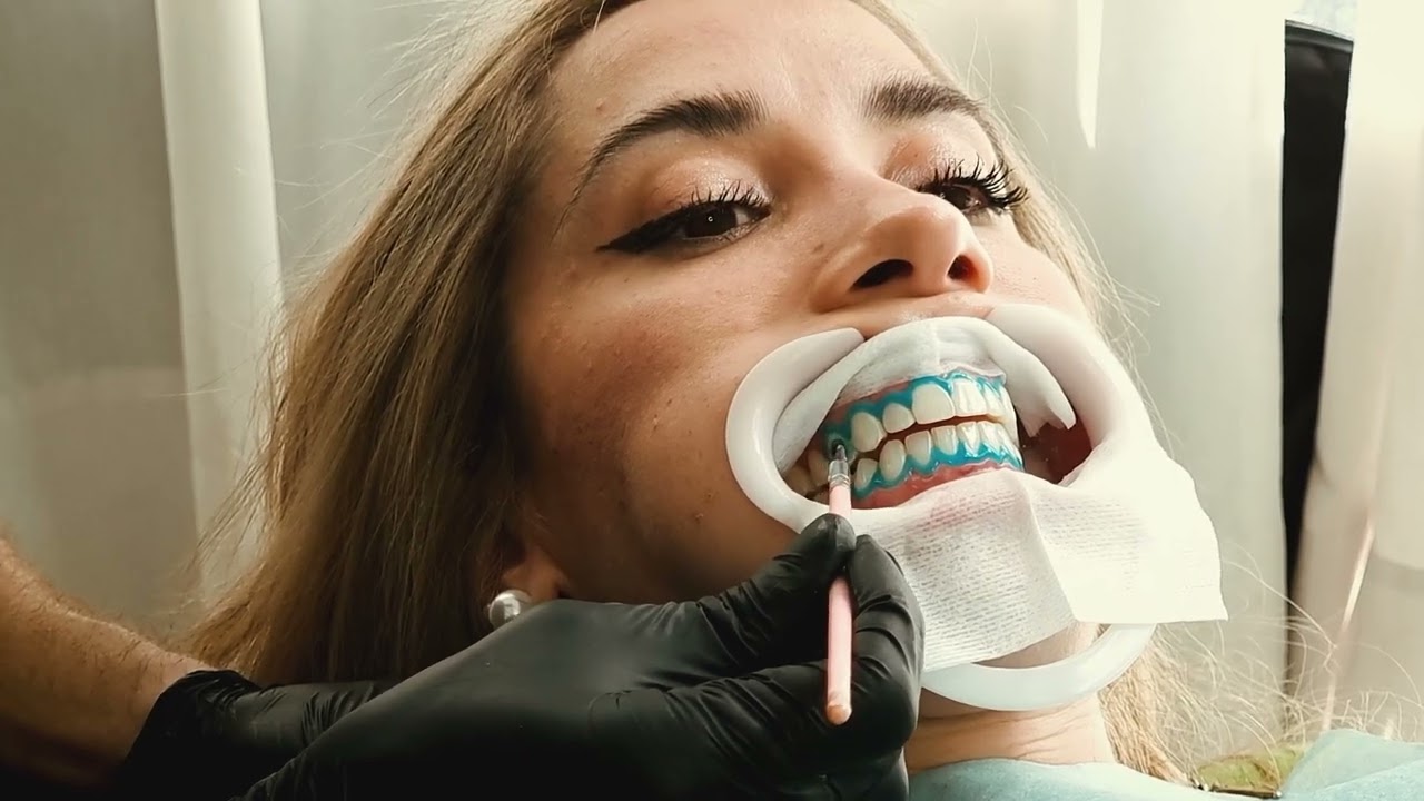 Kit de Blanqueamiento Dental Clarident