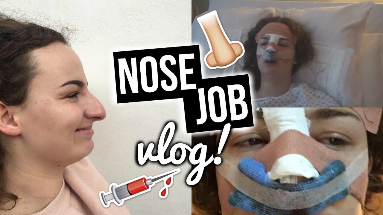NOSE JOB VLOG?!
