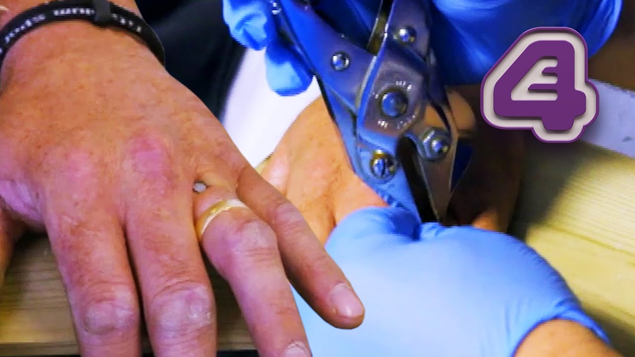 Nail Guns Hand to Plank of Wood - Uses Pliers to Get it Out | Bizarre ER