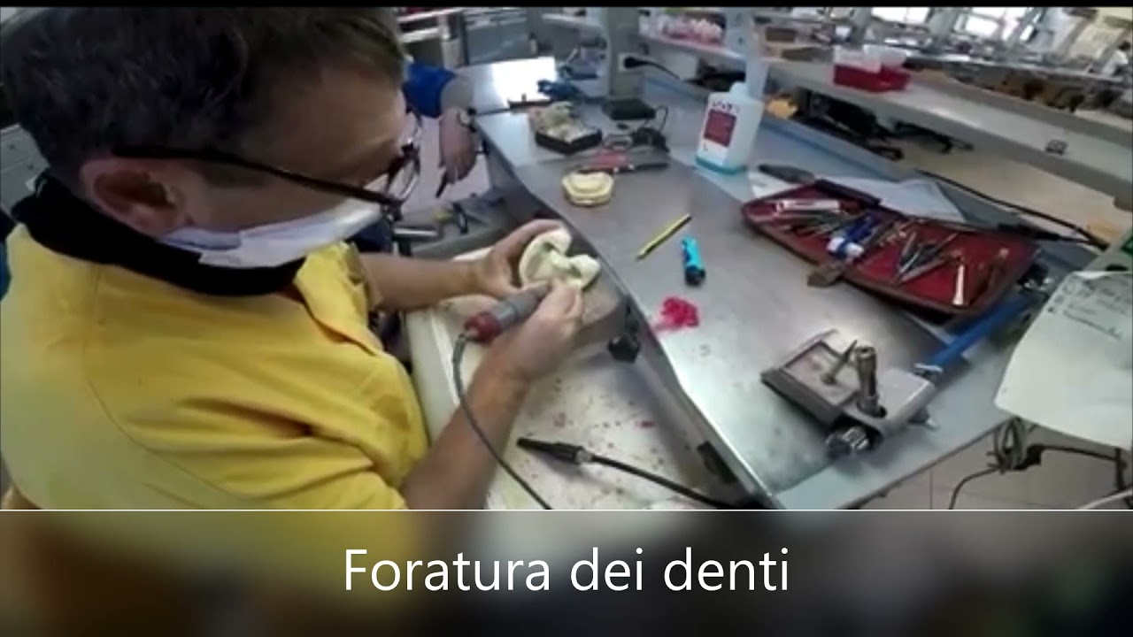 Resinatura di protesi autopolimerizzabile con tecnica di colata