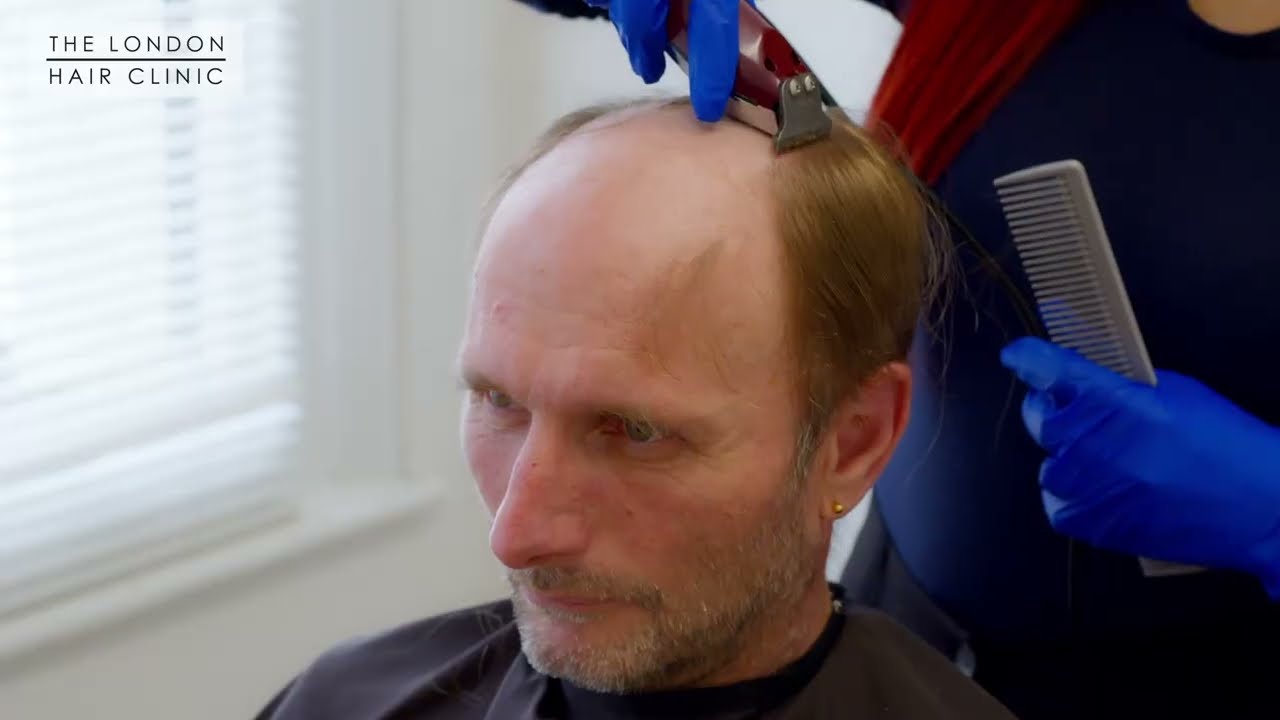 #hairsystem #hairreveal  Hair System | Before & After | Non-Surgical Hair Replacement System for men