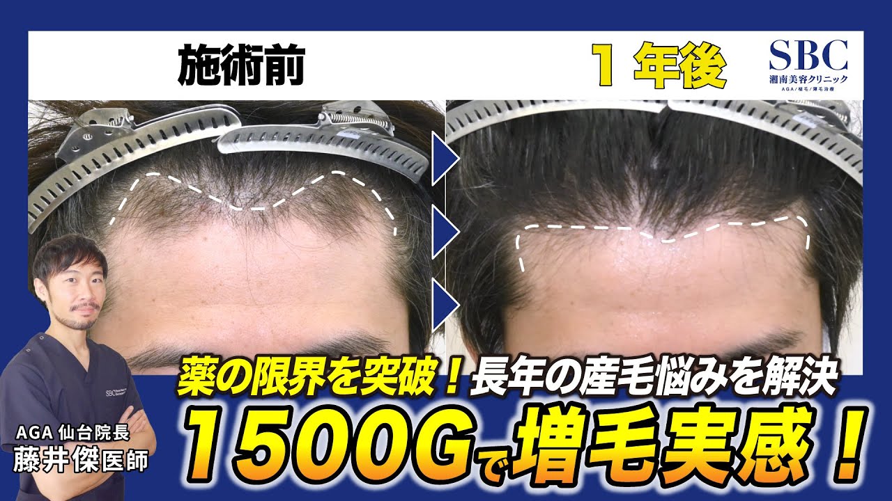 【AGA薬の限界】6年飲んでも産毛のまま…自毛植毛1500株で前髪が劇的復活【30代症例】