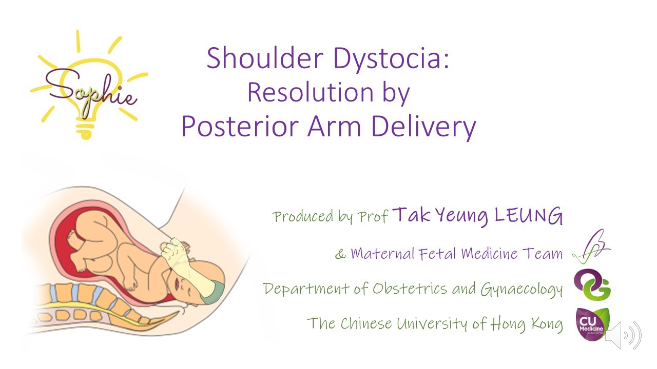 Shoulder Dystocia : Resolution by Posterior Arm Delivery - OBG CUHK