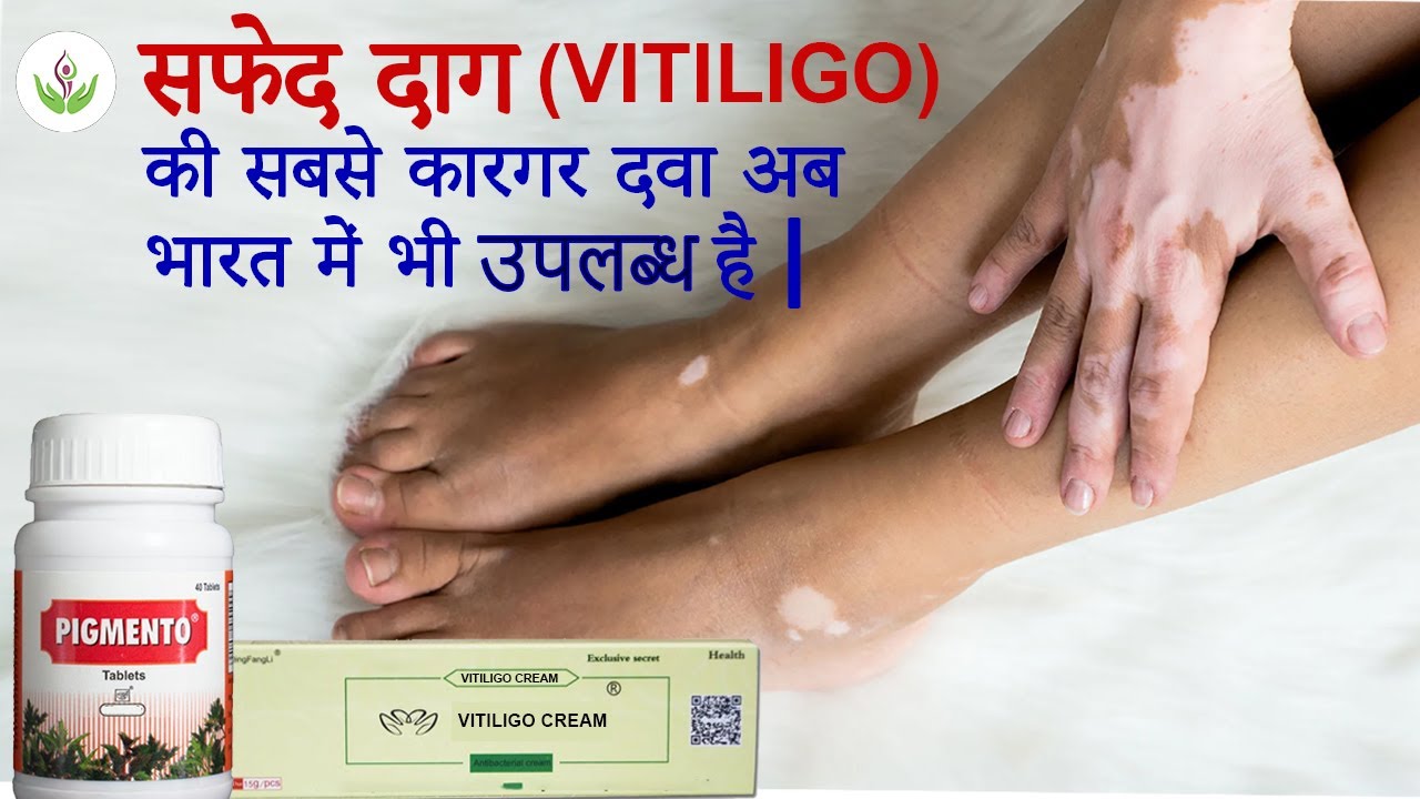 सफेद दाग (Vitiligo) की सबसे कारगर दवा अब भारत में भी उपलप्ध है 2024 | केयर वेल मेडिकल सेंटर