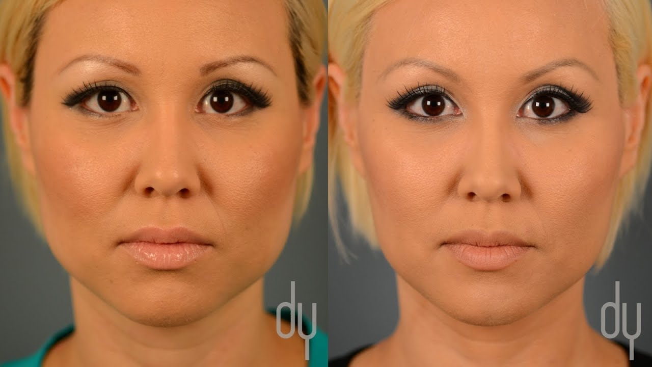 BOTOX&reg; for Masseter Reduction | Before + After | Jaw Reduction + Tapering Reviews - Beverly Hills