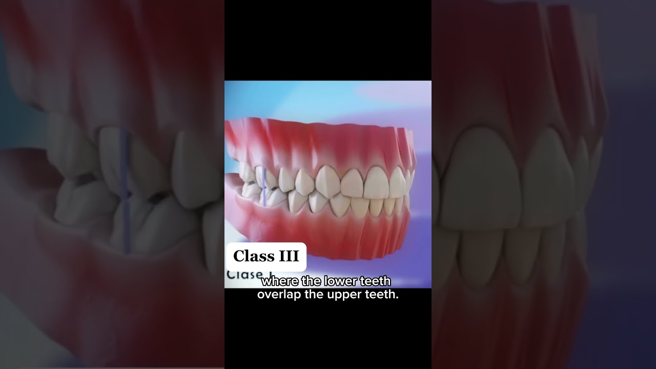 Class III Maloccluson - Explaining Class III Malocclusion in classic, &ldquo;Dr. Mike&rdquo; style!