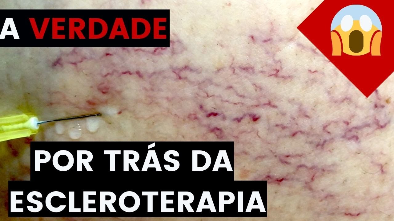 A VERDADE por trás da ESCLEROTERAPIA (aplicação) de VARIZES: Não faça se você NÃO souber isso!