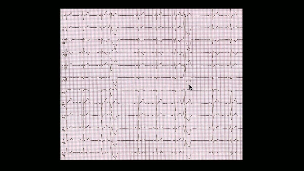 Timing Bipolar and Unipolar Atrial Electrograms, Part III, with Warren 